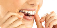 Invisalign treatment