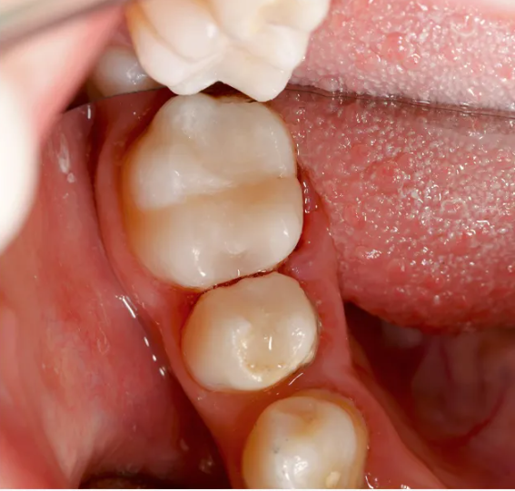 Filled tooth with composite resin