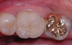 Gold Fillings Teeth after image