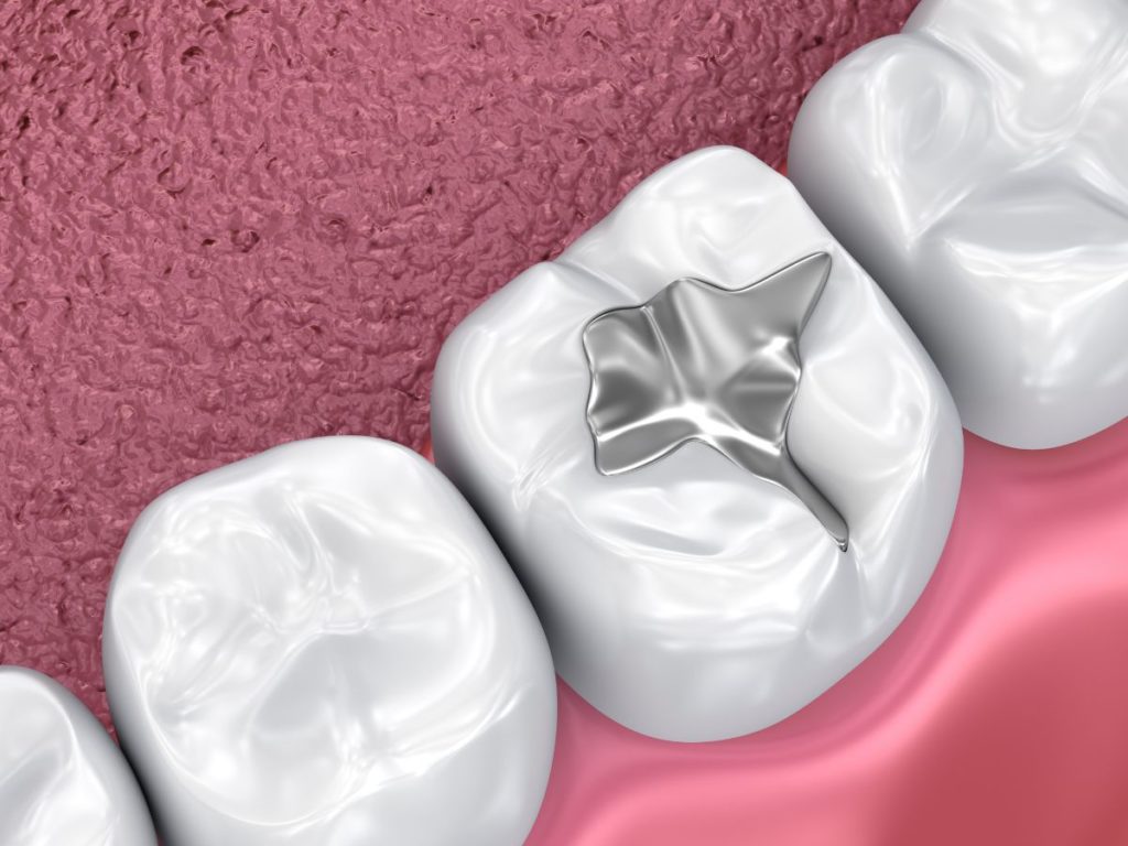 Dental Filling