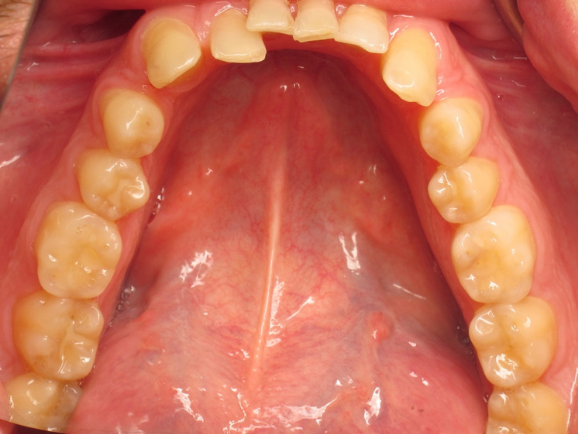 Invisalign before 2
