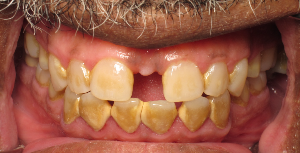 Invisalign & Gum Treatment before 1