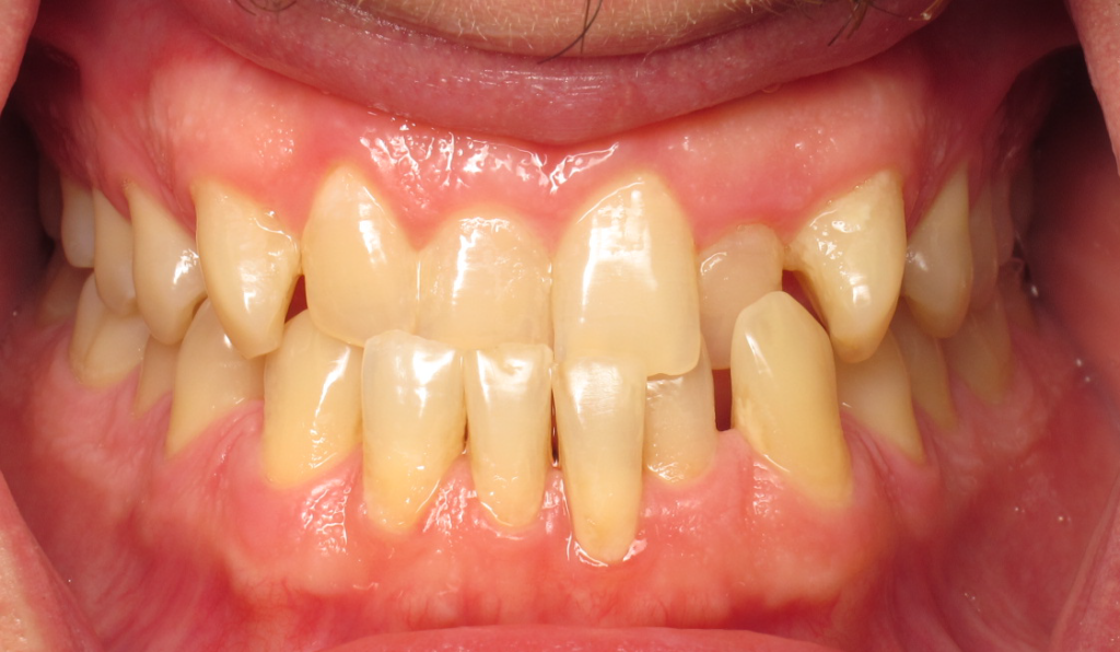 Invisalign before 1