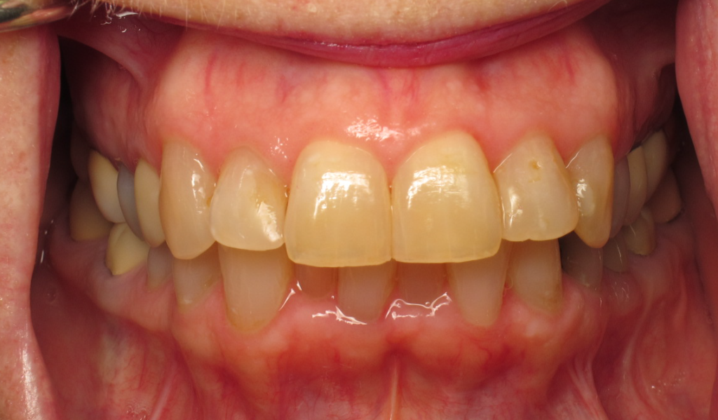 Invisalign & Whitening before 1