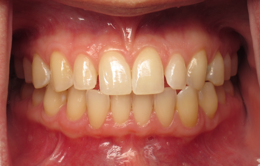 Invisalign & Veneers before 1