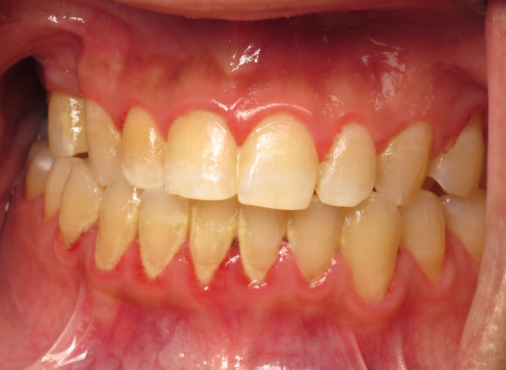Gum Treatment before 1