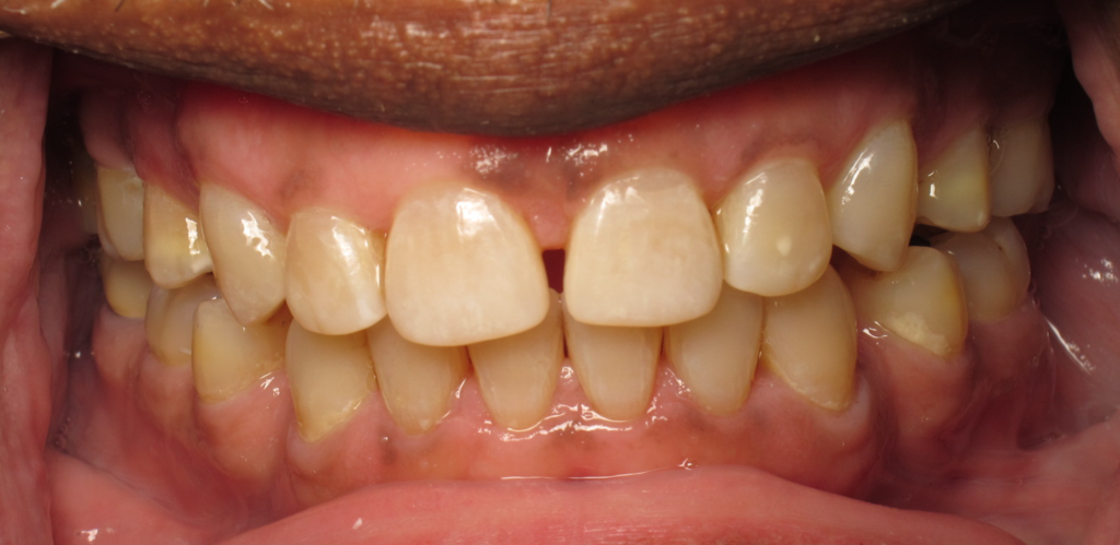 Invisalign & Gum Treatment after 1