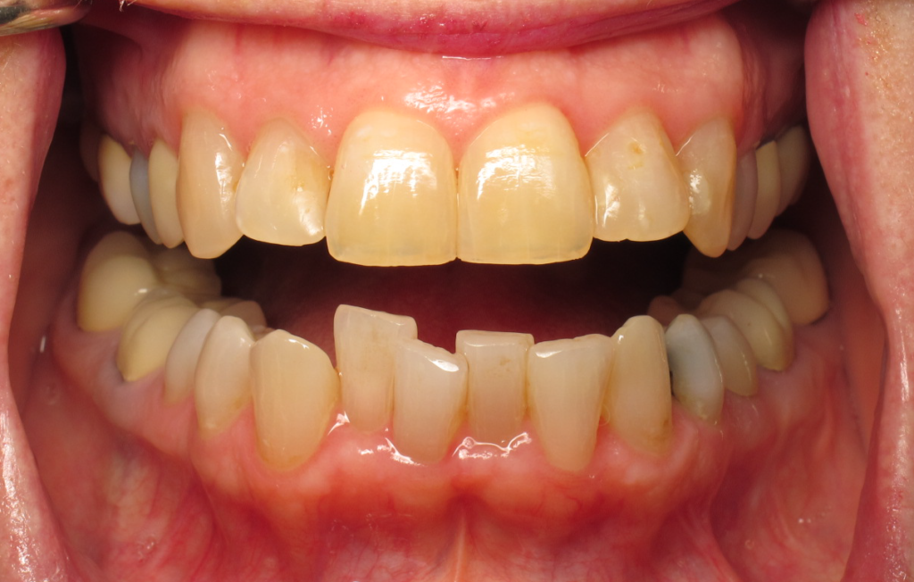 Invisalign & Whitening before 2