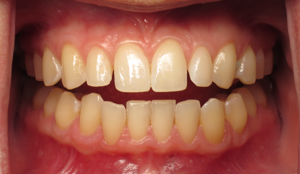 Invisalign & Veneers before 2