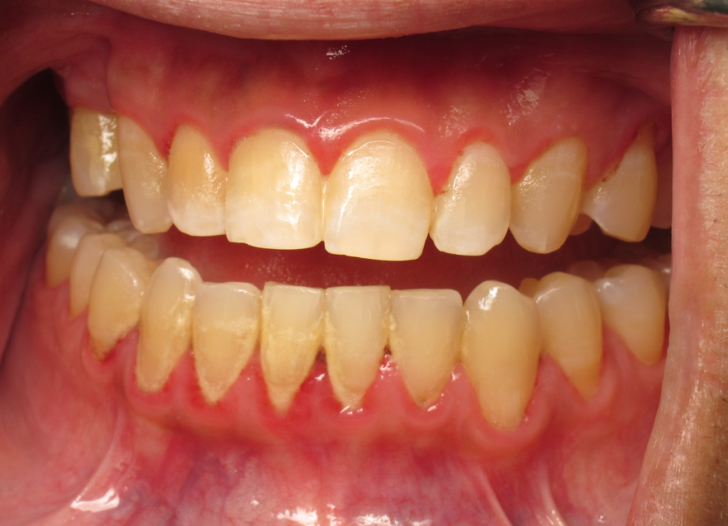 Gum Treatment before 2