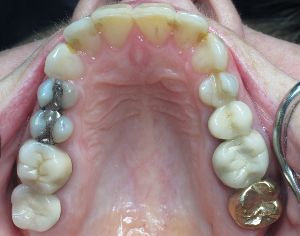 Invisalign & Whitening before 3