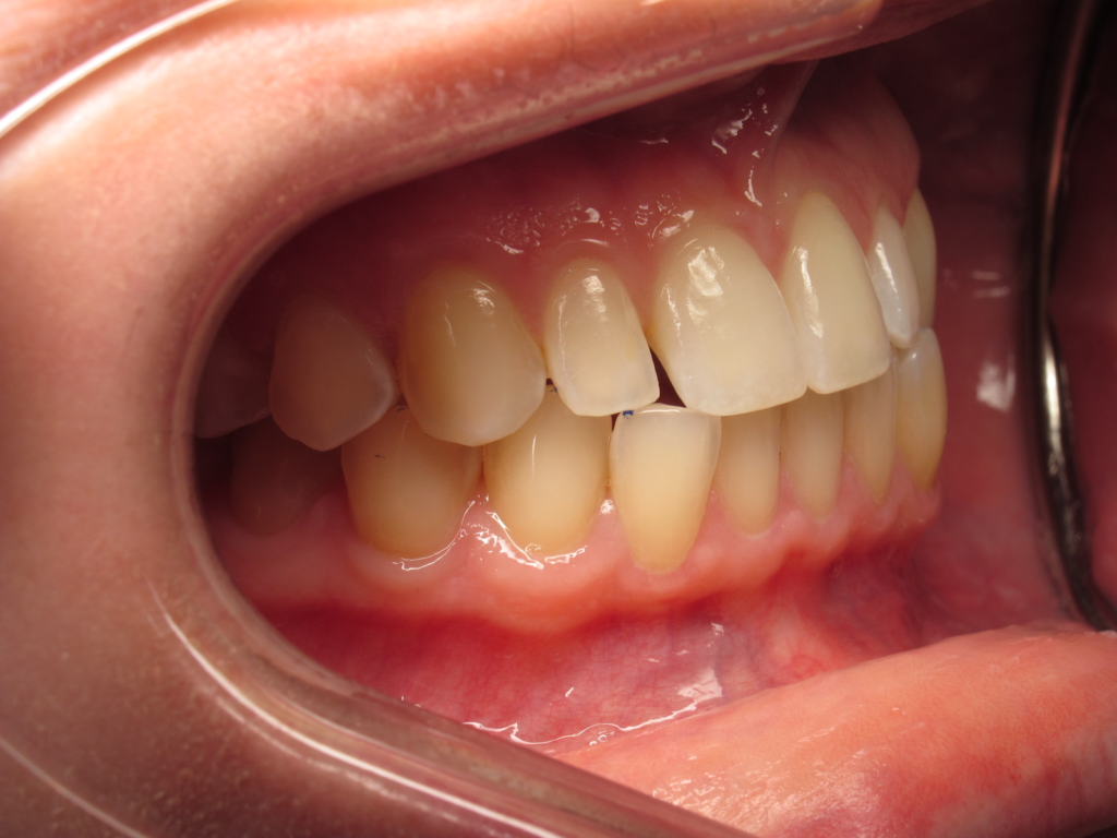Invisalign & Veneers before 3
