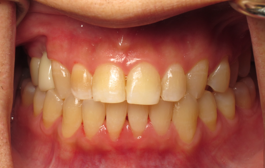 Gum Treatment after 1