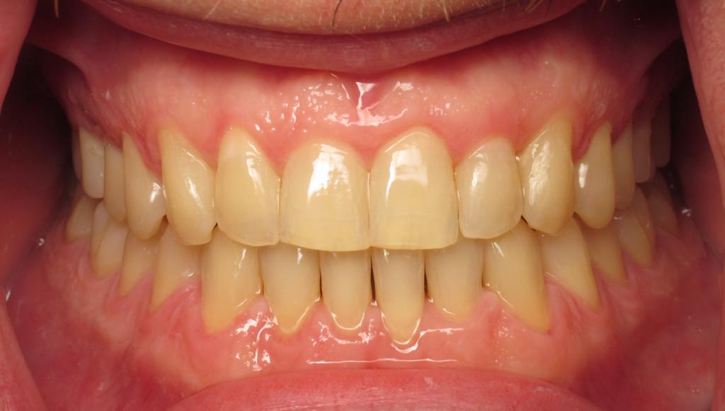 Invisalign after 1