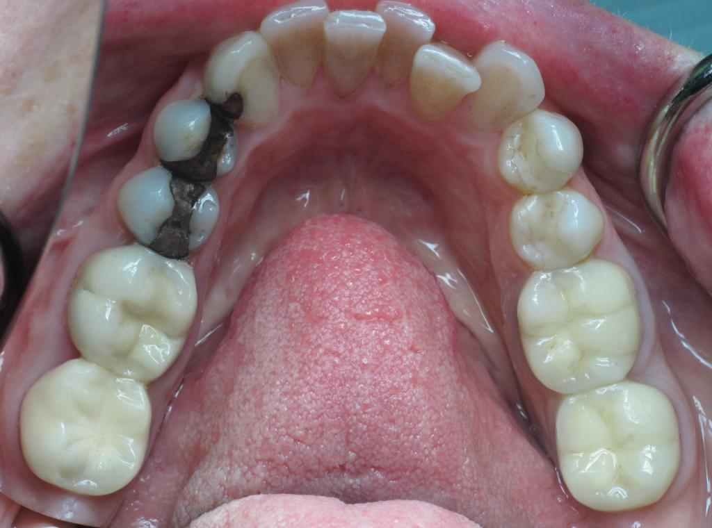 Invisalign & Whitening before 4