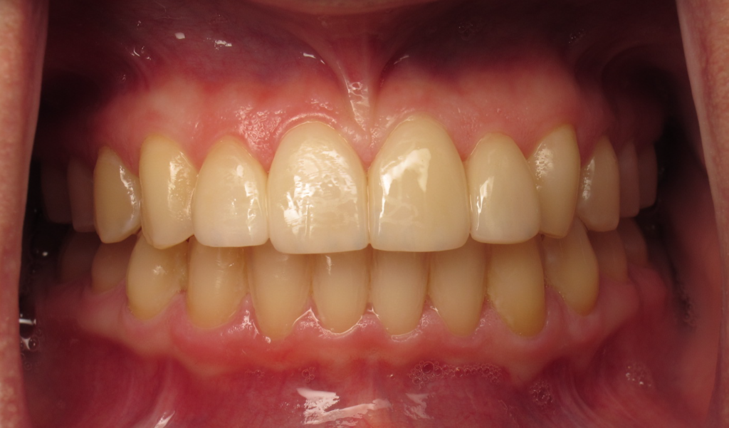 Invisalign & Veneers after 1