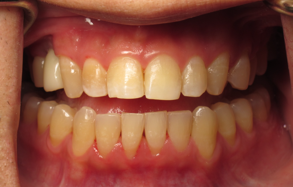 Gum Treatment after 2