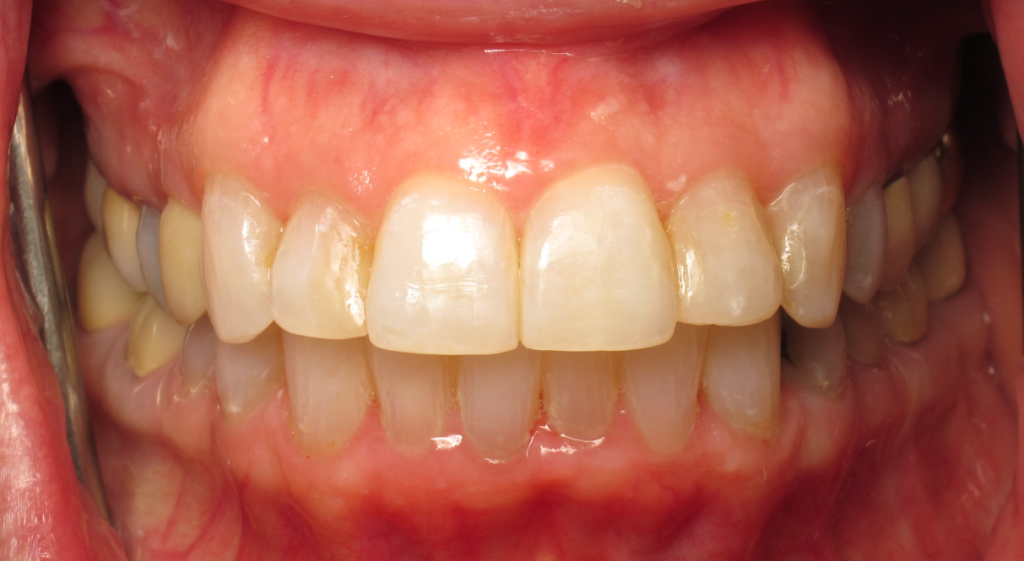 Invisalign & Whitening after 1