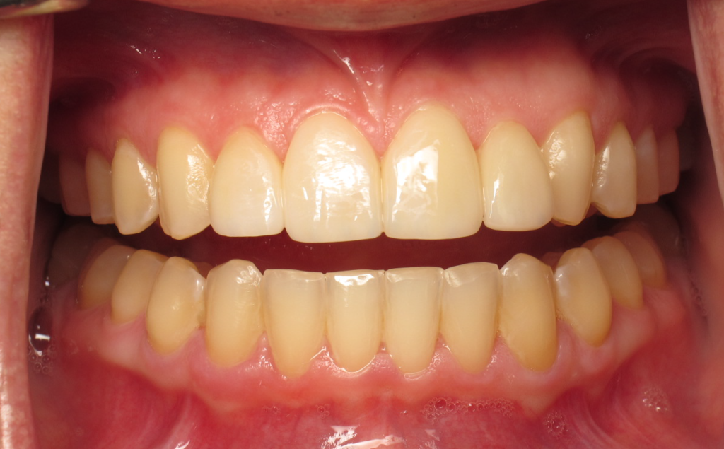 Invisalign & Veneers after 2