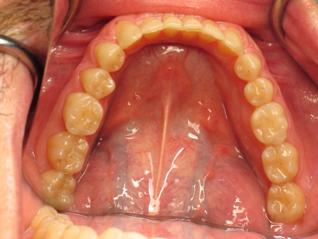 Invisalign after 2