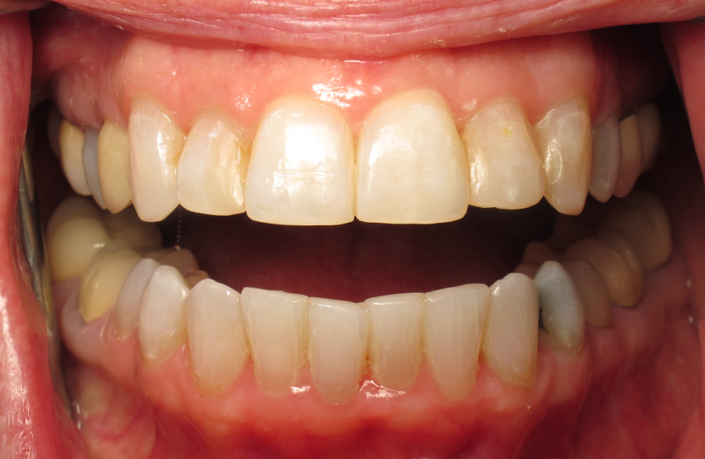 Invisalign & Whitening after 2