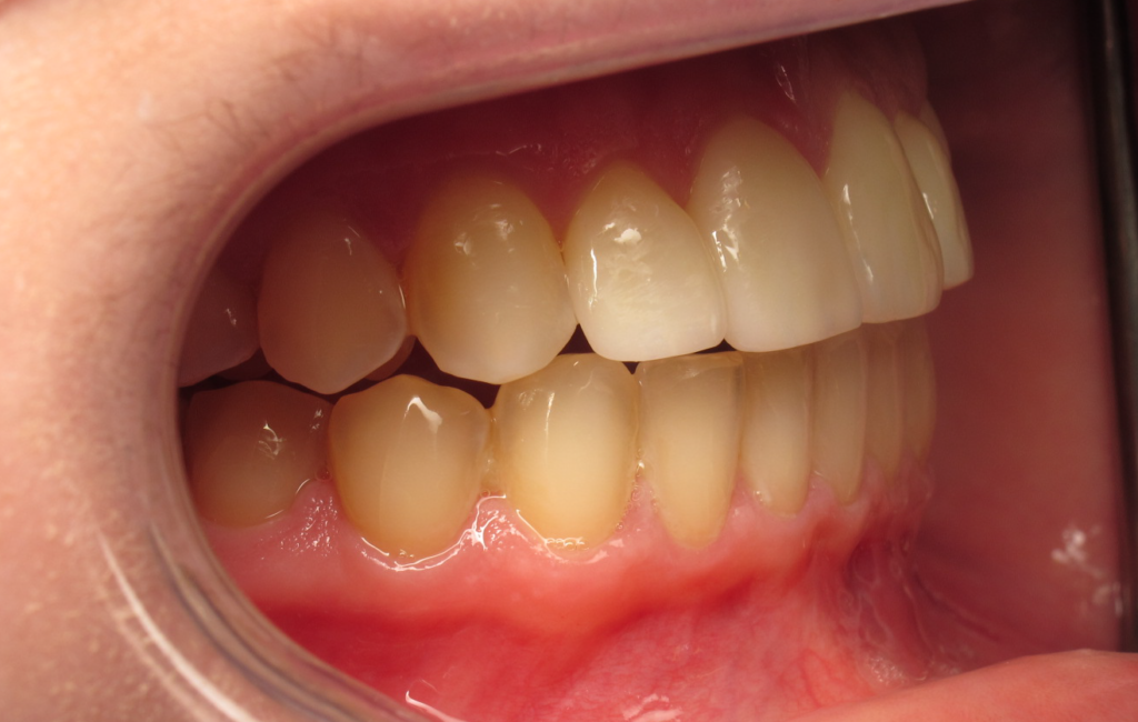 Invisalign & Veneers after 3