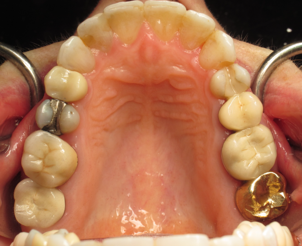 Invisalign & Whitening after 3