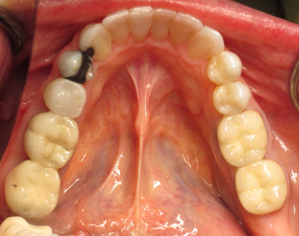 Invisalign & Whitening after 4